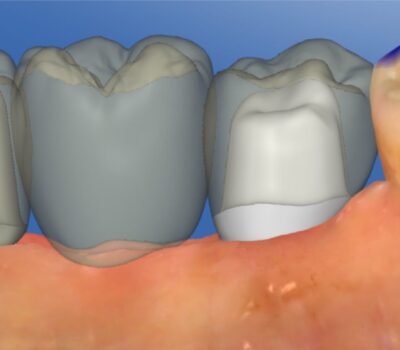 Implanty zębów <span>Łask</span> 11