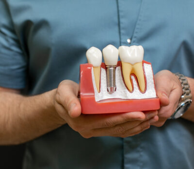 Czy implanty zębowe są bezpieczne? 1