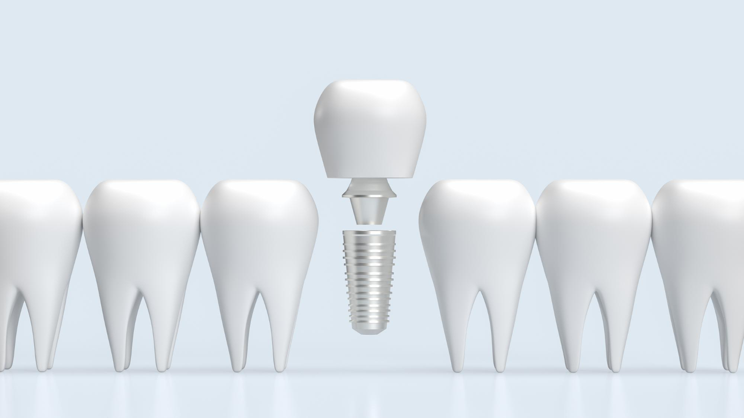 Implantacja natychmiastowa – usunięcie zęba i wszczepienie implantu w jednym zabiegu 2